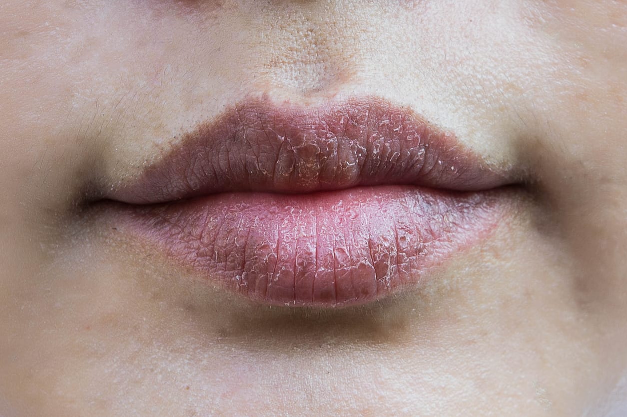 Cara Menghilangkan Noda Hitam Di Bawah Bibir  Menghilangkan Masalah