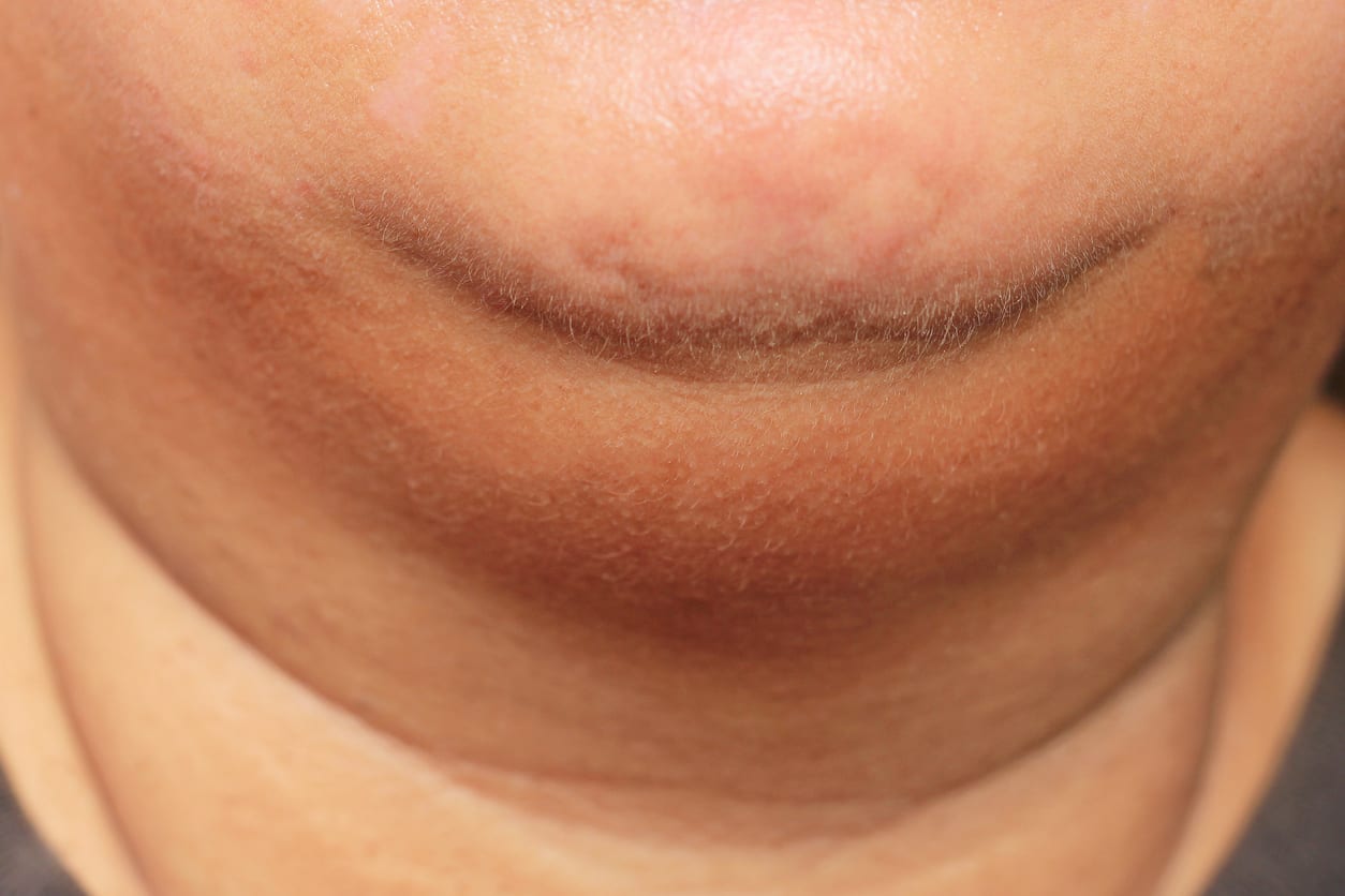 Cara Menghilangkan Double Chin Untuk Pria Dan Wanita Honestdocs