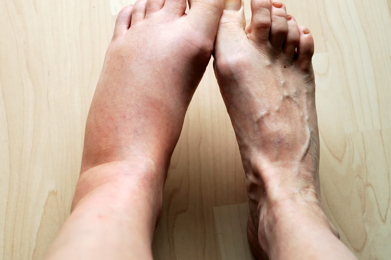 Kenapa Kalau Kaki Bengkak Posisi Kaki Harus Lebih Tinggi Honestdocs