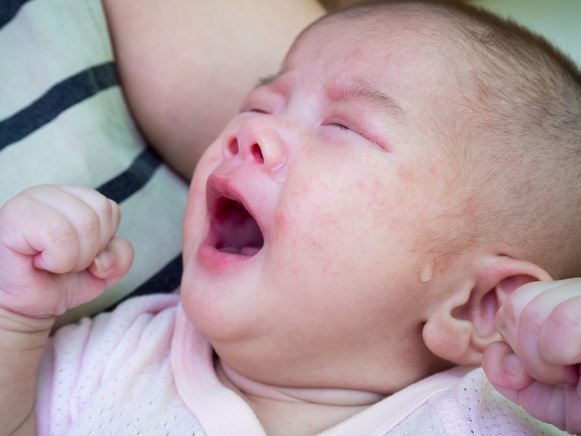 3 Penyebab Utama Ruam Pada Mulut Anak Dan Cara Mengatasinya Honestdocs