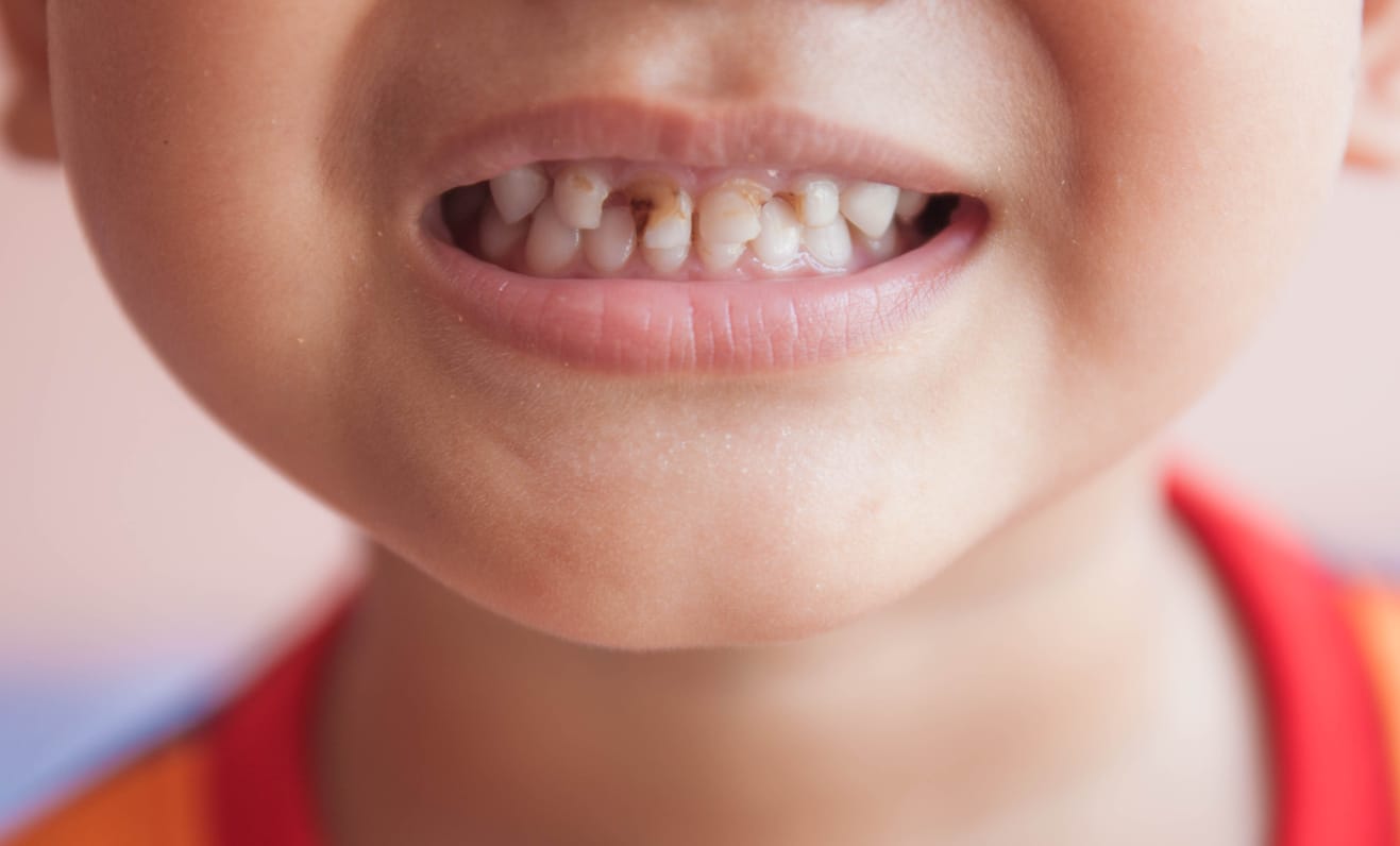 孩子牙齿黑斑的疗愈 | 安疗网