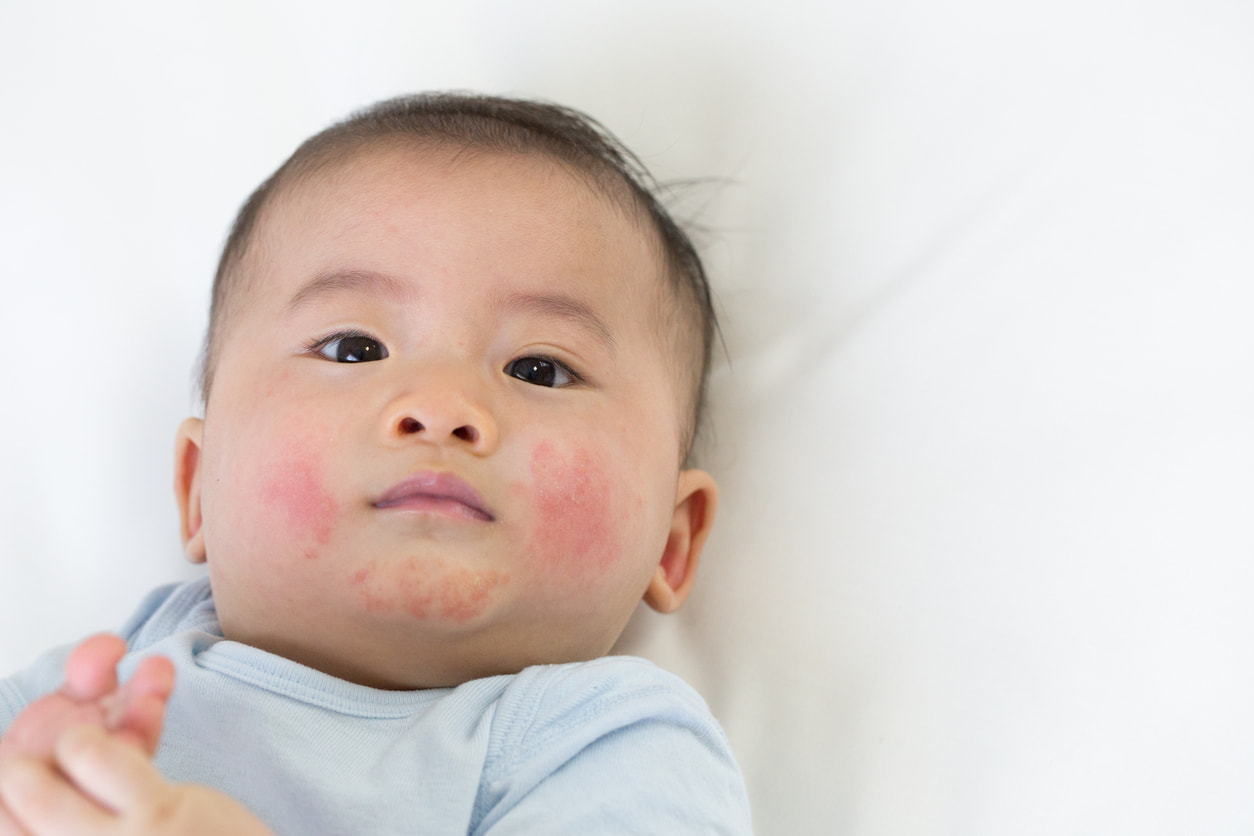5 Cara Mengobati Dermatitis Atopik Pada Bayi Honestdocs
