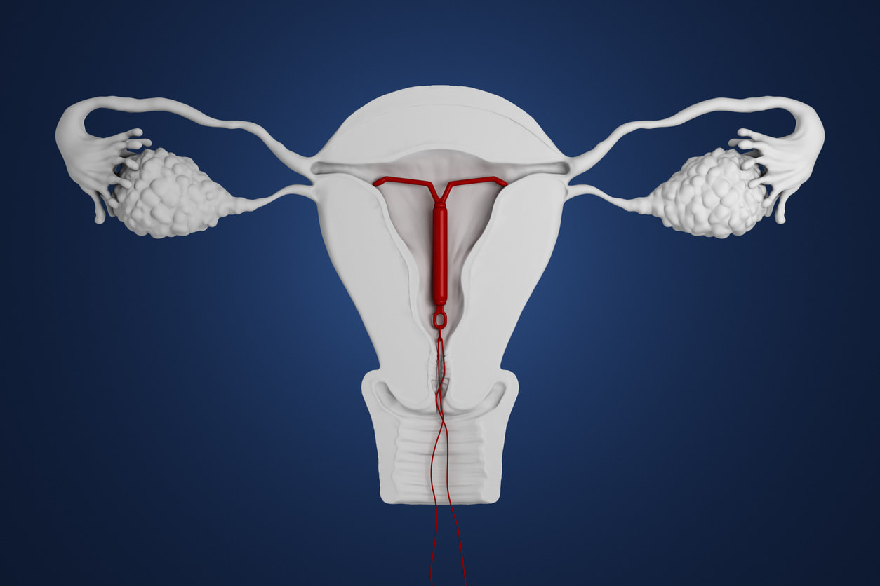 Benang IUD Tidak Terasa? Ini Tindakan yang Harus Dilakukan ...