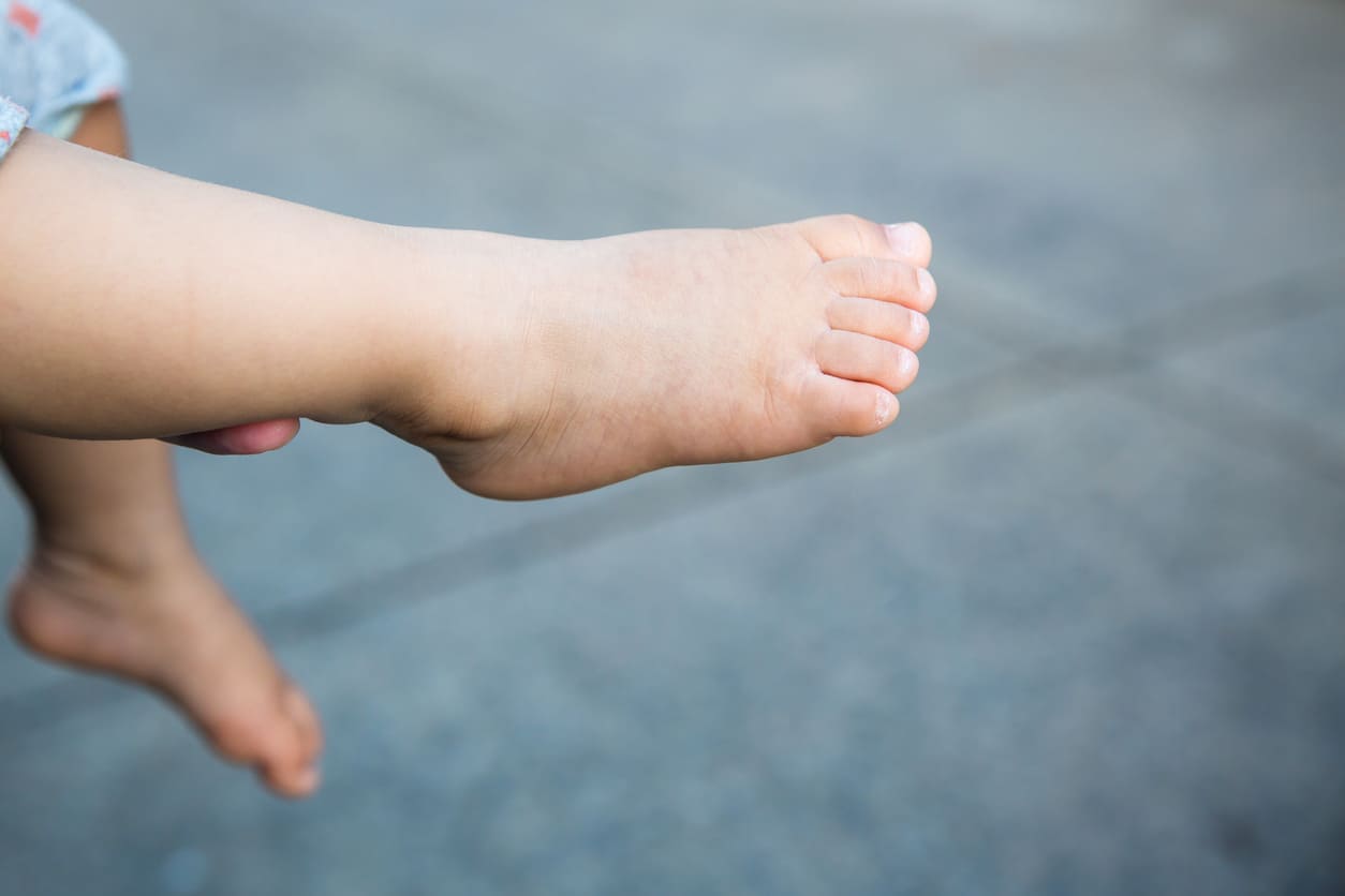 Flatfoot Pada  Anak Penyebab Gejala dan Obat Update 