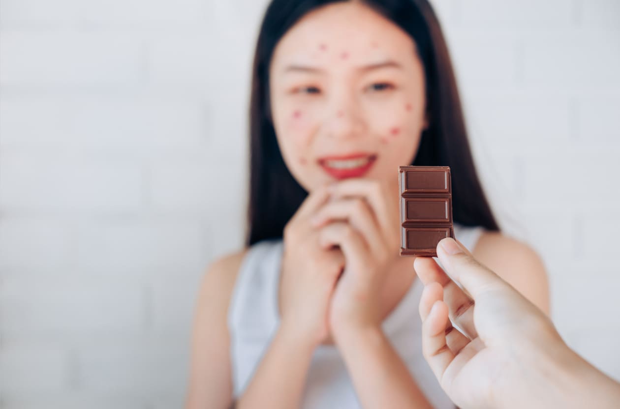 Apakah Benar, Makan Coklat Kebanyakan Bisa Bikin Jerawatan ...
