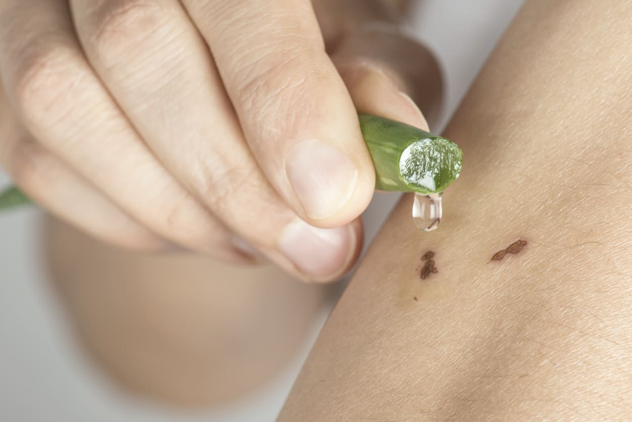 Cara Mudah Menghilangkan Bekas Luka pada Kulit | HonestDocs