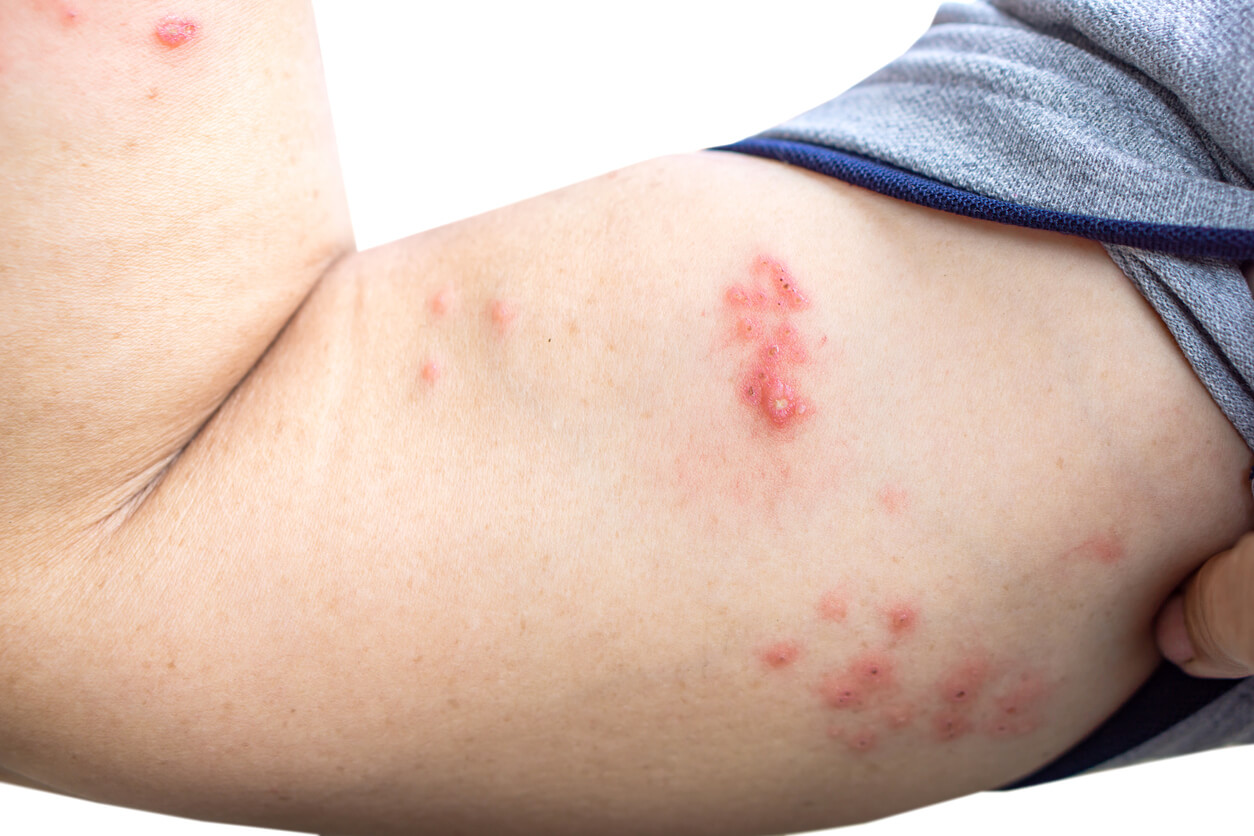 Rekomendasi Obat Untuk Penyakit Kulit Herpes Honestdocs