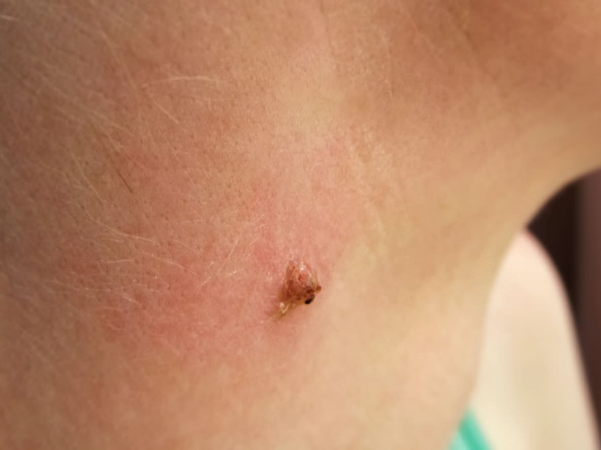 Kutil Di Leher Dapat Menular Cari Tahu Cara Mengatasinya Honestdocs