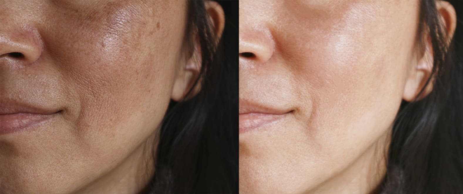Ketahui Cara Mengatasi Flek Hitam Melasma di Wajah 