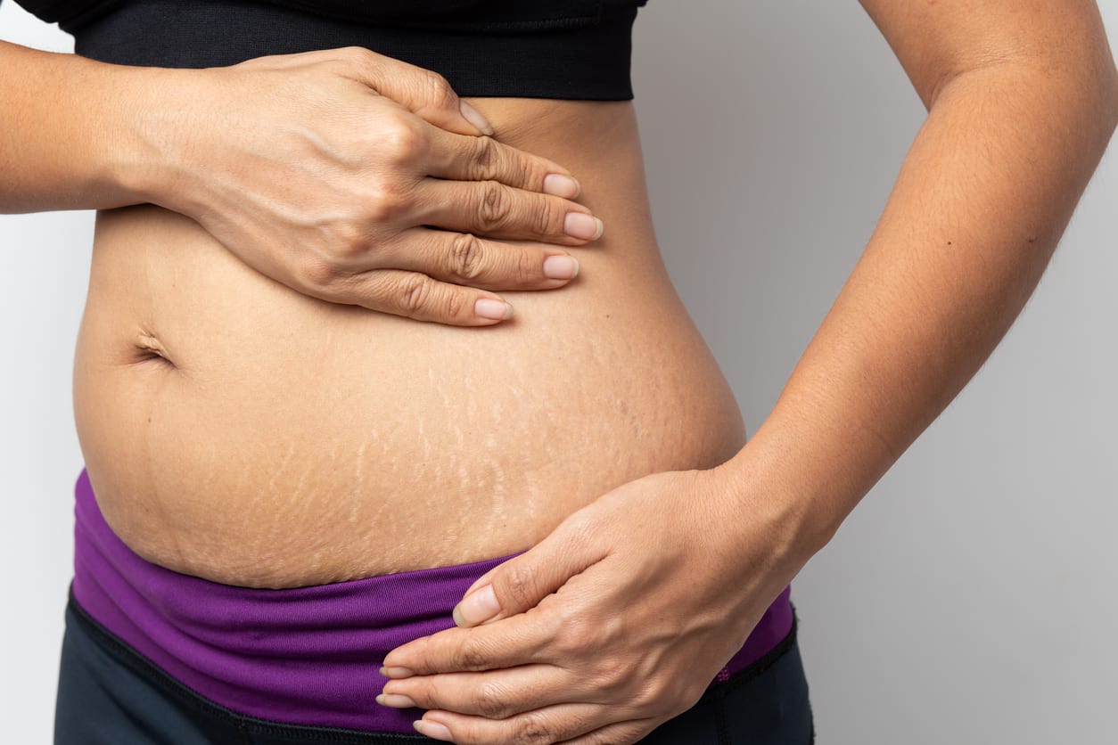 Manfaat Minyak Kelapa Untuk Menghilangkan Stretch Marks Honestdocs