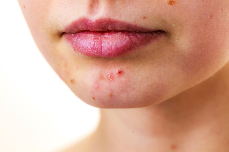 Fungal Acne Bukan Jerawat, Ini Ciri-cirinya | HonestDocs