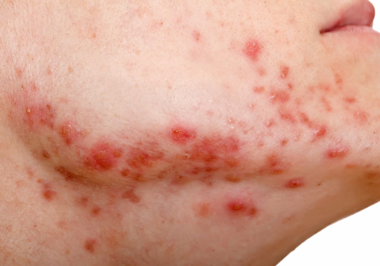 Magas vérnyomással járó vasculitis - Ritka Gyermekkori Elsődleges Szisztémás Vaszkulitisz