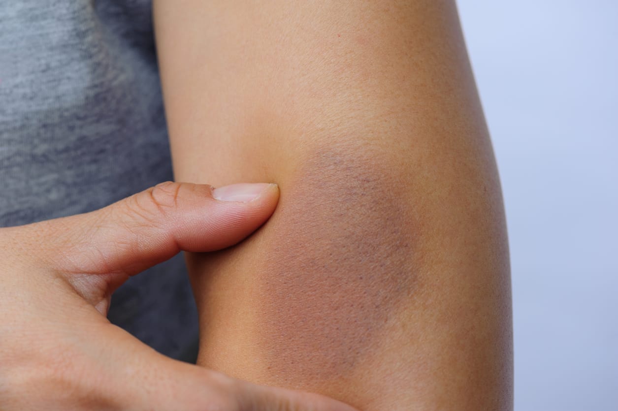 hematoma dupa suprapunerea chirurgiei