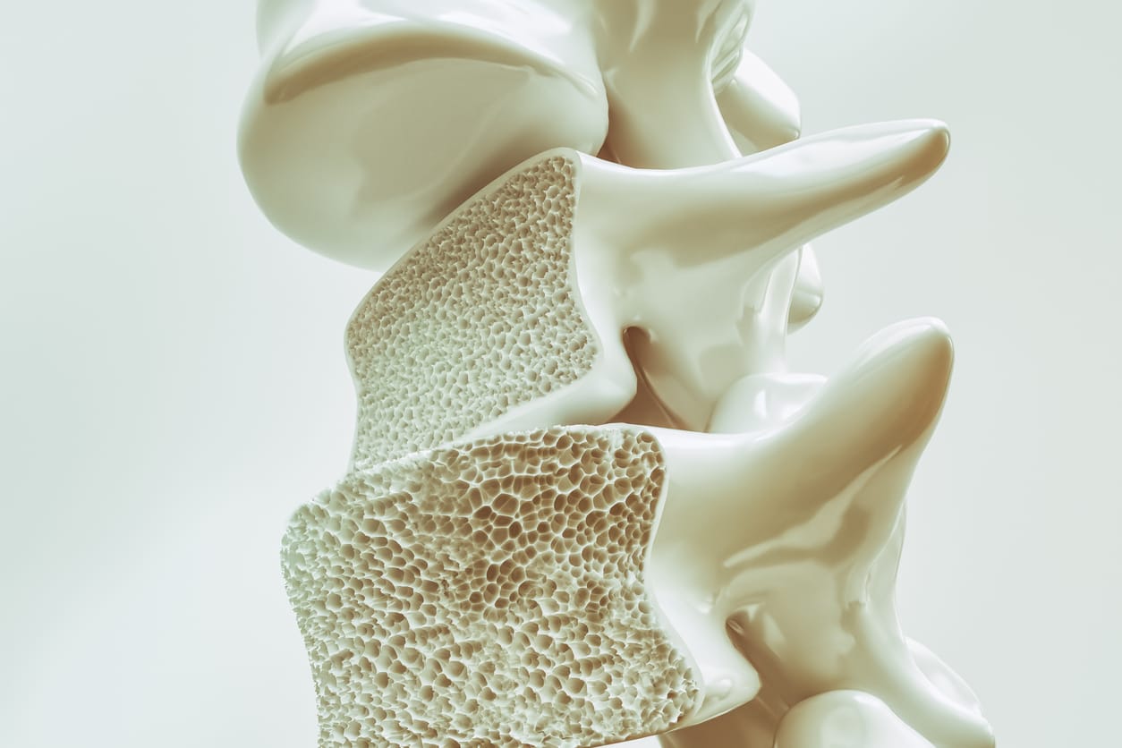 Osteoporosis Adalah? - Tanda, Penyebab, Gejala, Cara Mengobati | HonestDocs