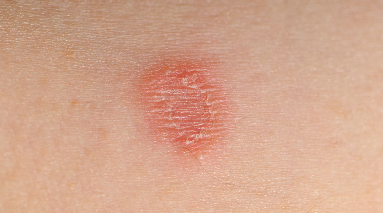 Tinea Corporis Adalah? - Tanda, Penyebab, Gejala, Cara Mengobati