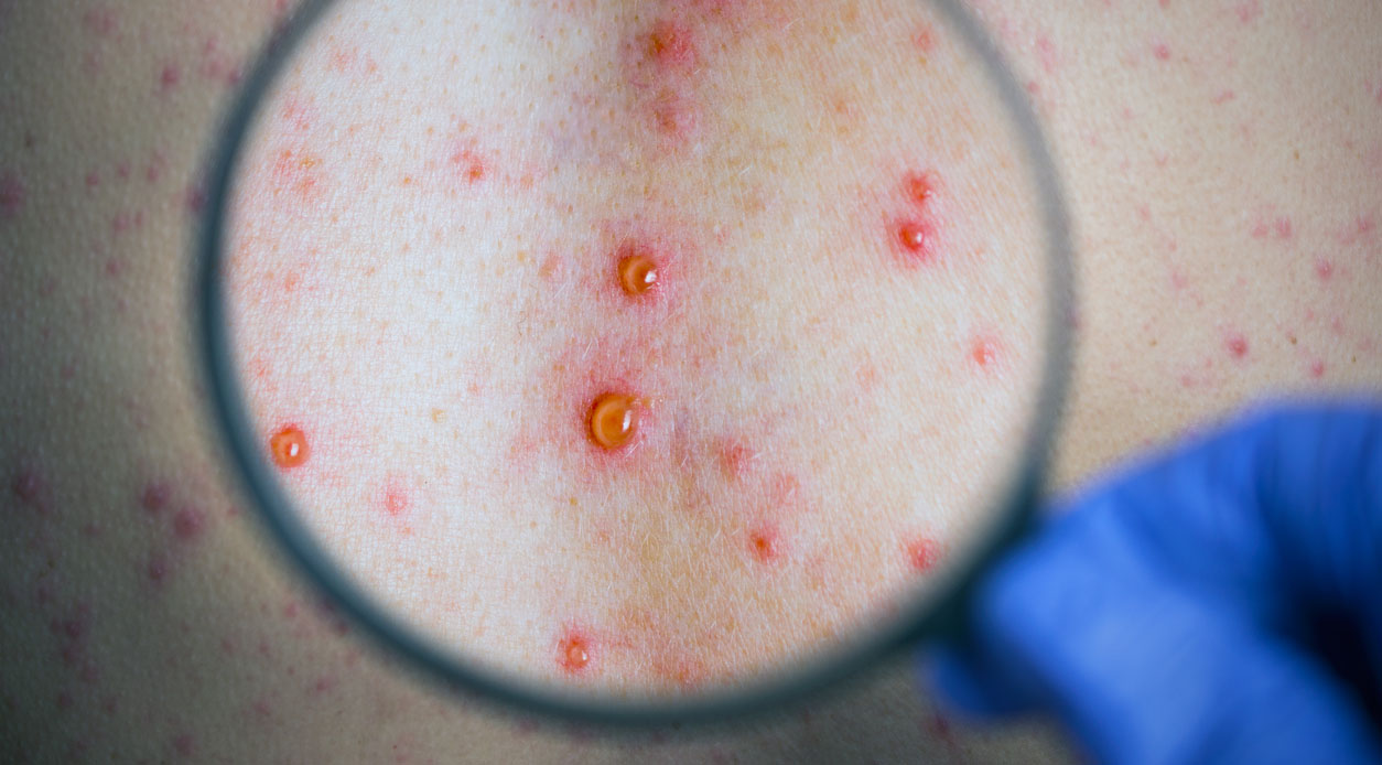 Syphilis - Gejala, Cara Menangani, dan Obat | HonestDocs