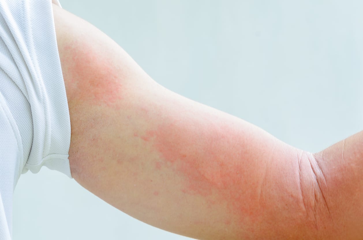 Dermatitis Kontak Alergi Gejala Cara Menangani Dan Obat Honestdocs
