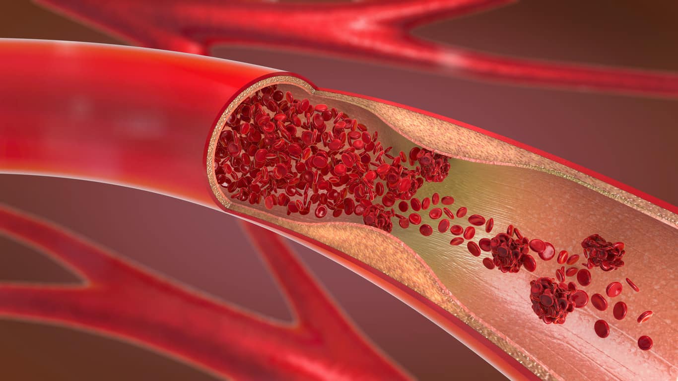 Varicoză anemie, Despre anemii