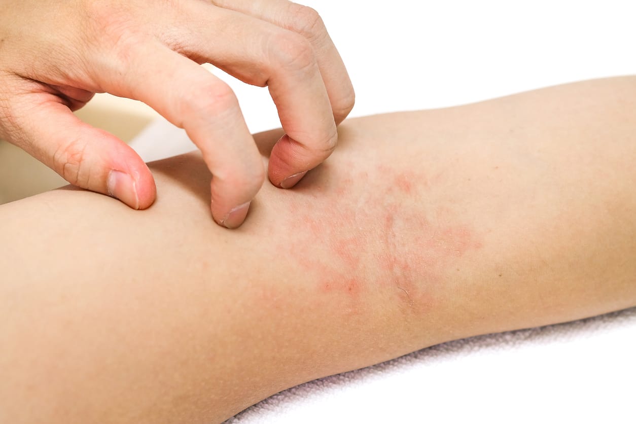 Dermatitis numular adalah penyakit kronis (jangka panjang) yang ditandai dengan bercak-bercak berbentuk koin pada permukaan kulit.
