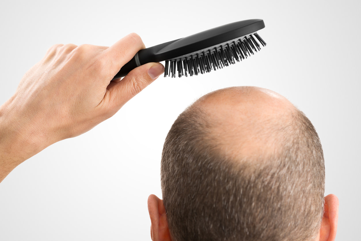 Alopecia Areata Adalah? - Tanda, Penyebab, Gejala, Cara Mengobati