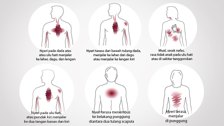 Siang Dok Saya Toto Umur 43 Dada Saya Nyeri Dan Sesak Kayak Ada Beban Yg Menindih Kalau Dikasih Obat Aspilet Dada Terasa Lega Tapi Selang Beberapa Waktu Kemudian Pasti Kambuh Lagi Apakah