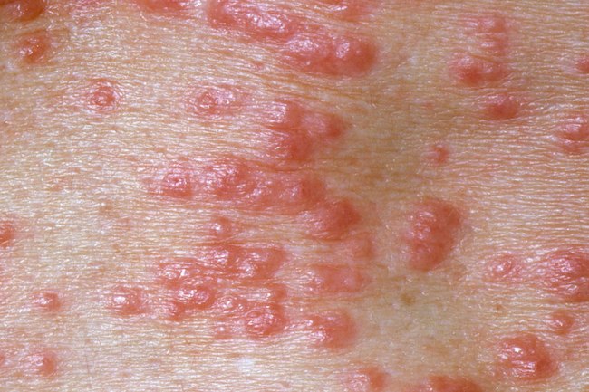 1800ss princ rm photo of scabies skin infection