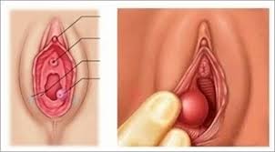 condilomul a crescut pe vagin hpv on the tongue