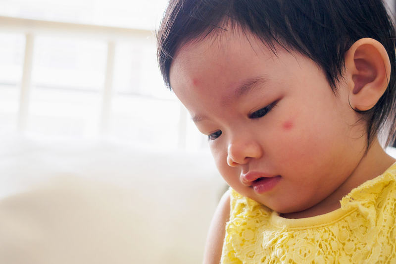 bintik merah pada wajah bayi bintik merah pada wajah bayi
